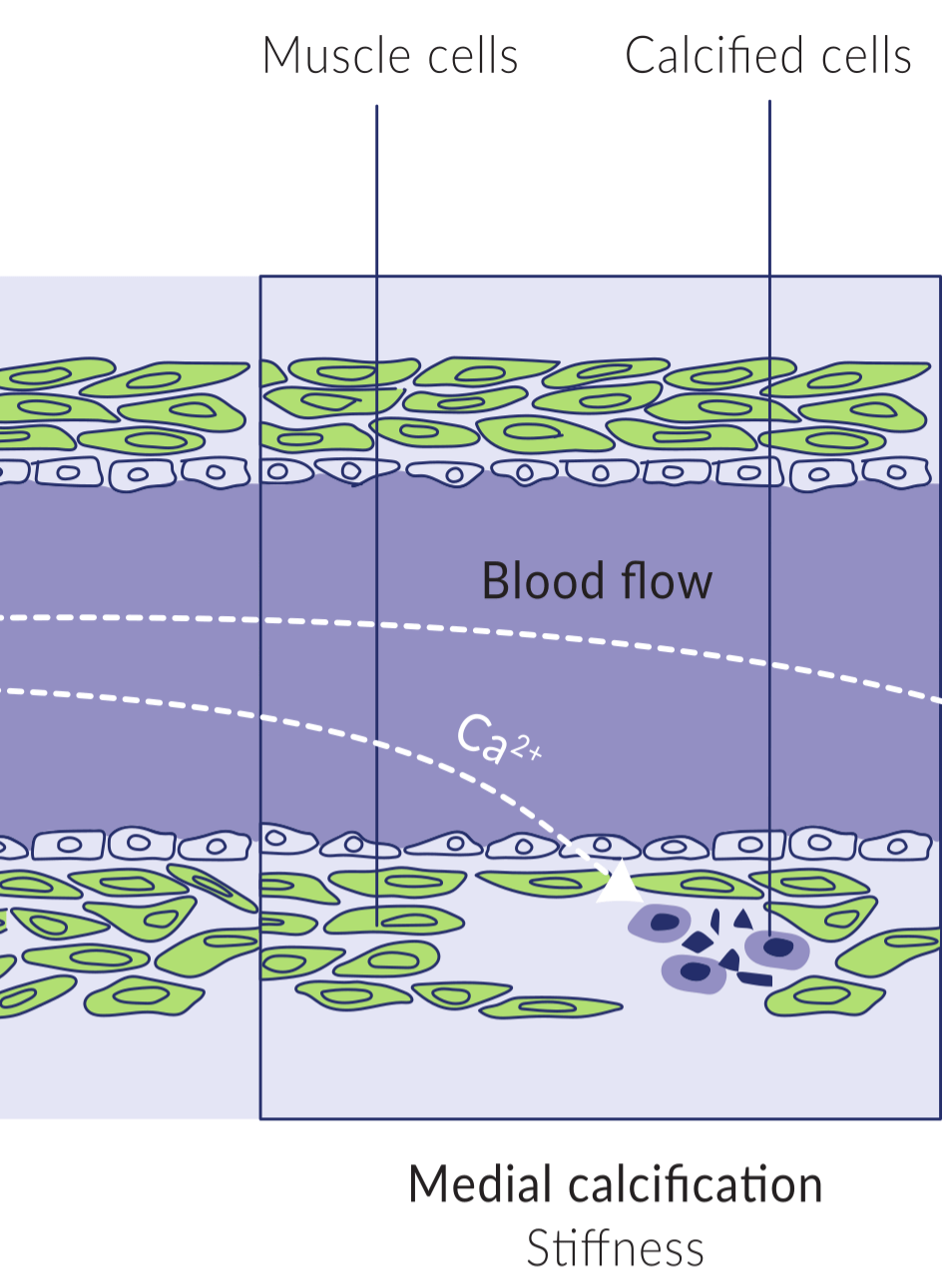 Calcification of Arterial Wall