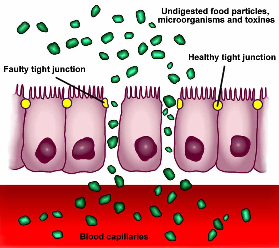 Leaky Gut